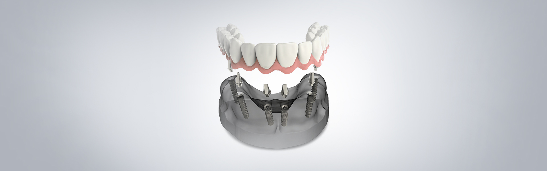 A Basic Guide to Immediate Dental Implants
