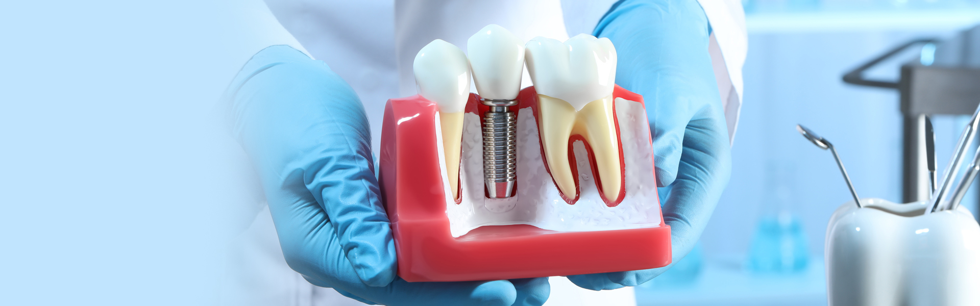 Immediate Implants Vs. Delayed Dental Implant: What's The Difference?