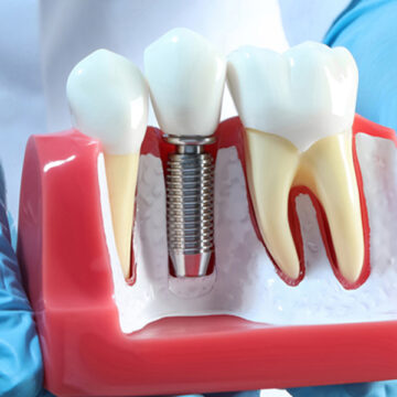 Reviving Confidence: Unveiling Dental Implants’ Advantages