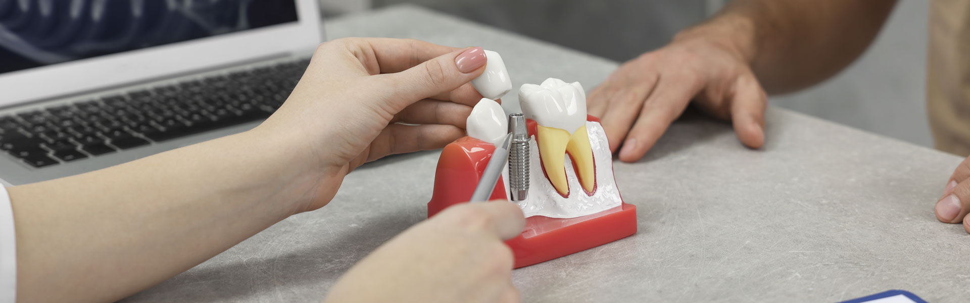 Implants Unveiled: A Comprehensive Journey into the World of Dental Implants